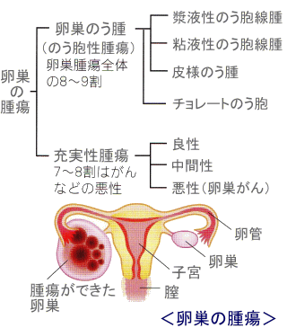 卵巣の腫瘍の種類